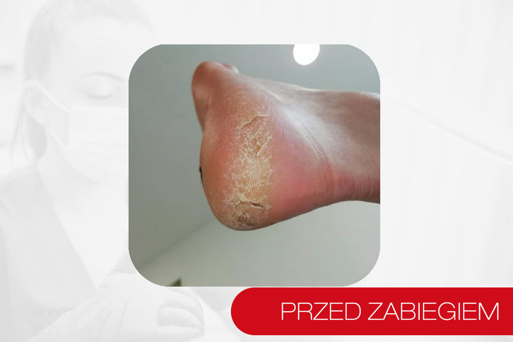 Podopharm PODOFLEX Гель для пом'якшення епідермісу для медичного педикюру — гель, що пом'якшує зроговілий епідерміс стоп